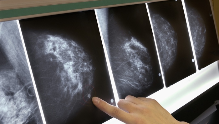 胸部检查,丑闻,筛查,患者,医疗资源,漏诊,兰帕德,泰晤士报,医疗系统,电脑故障