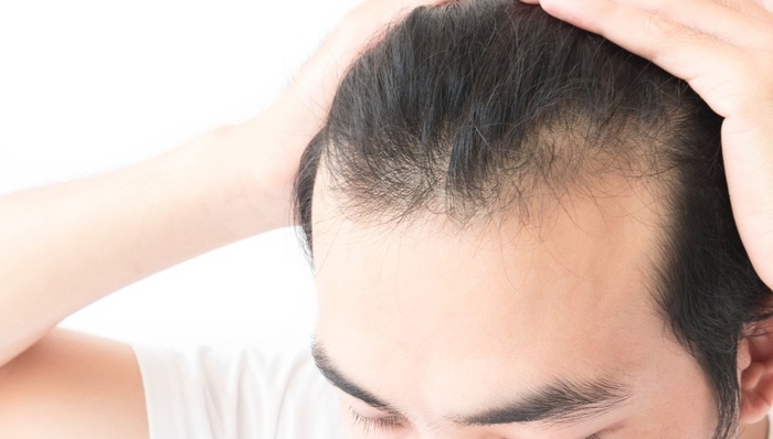 【3·15特别报道】一个香港男人决定去科发源植发