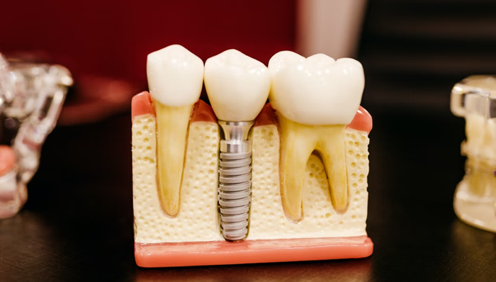 種植牙,集中采購