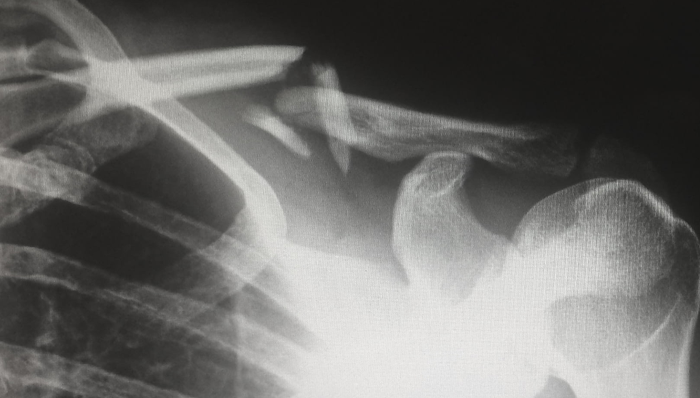 國(guó)產(chǎn)品牌,集中采購(gòu),降價(jià),骨科耗材