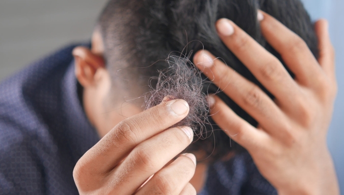 脫發(fā),年輕人,焦慮,防脫產(chǎn)品,健康,