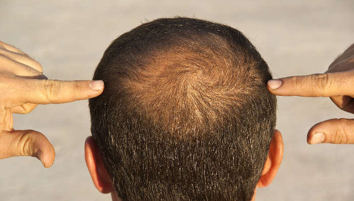 首款青少年治脱发药在国内获批,每盒价格或超千元