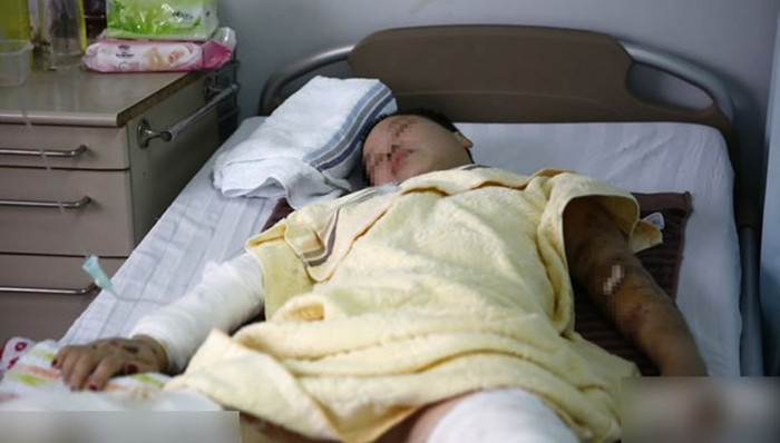 安徽,女子,被狗咬伤