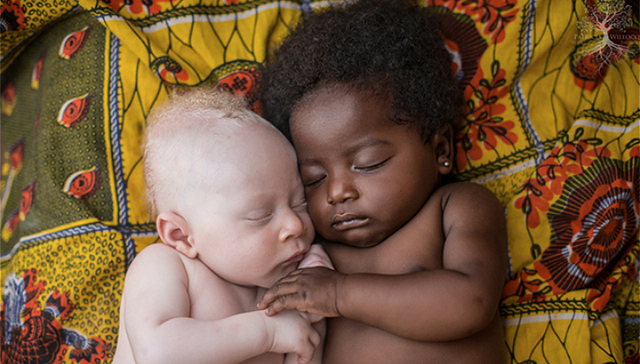 刚果,白化病,摄影,人道主义