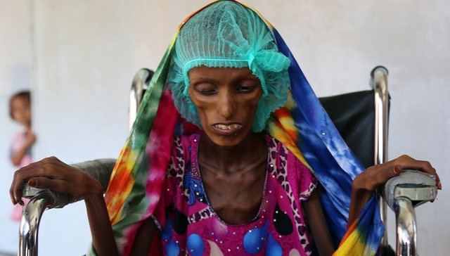 也门人道主义危机有多严重？看看这个营养不良的少女吧