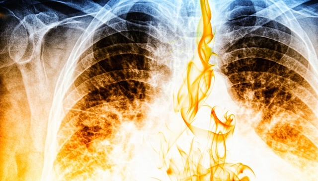 北京市民,恶性肿瘤,肺癌