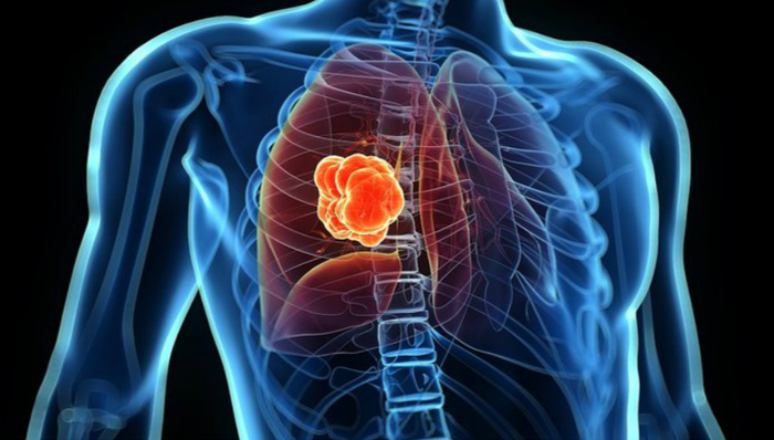 全球首例！“纳米枪”治疗肺癌试验在上海东方医院进行