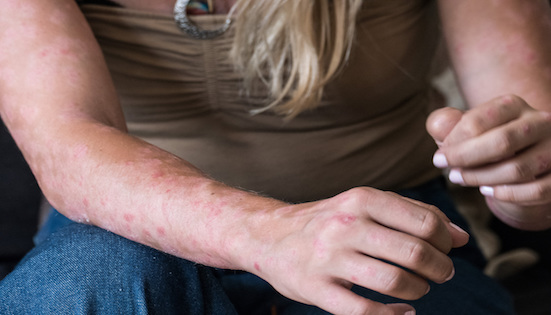 78%的患者曾遭受歧视、至今无法治愈 银屑病急需加强规范治疗