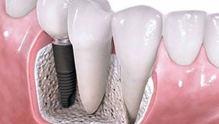 上万元牙植体成本仅几百元，口腔市场暴利链条解构