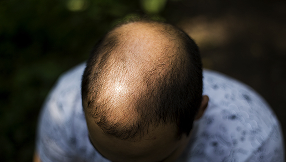 90后,投资,植发,医美