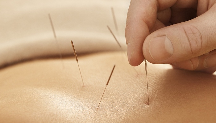 河南杞县百名患者针灸后皮肤溃烂，业内人士：应调查针具是否复用