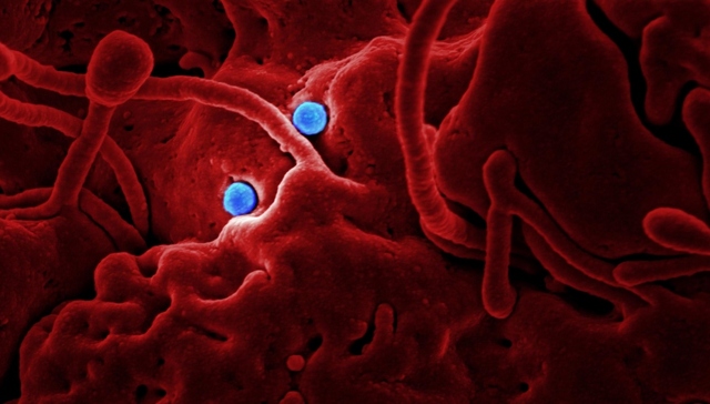 美国首例新型冠状病毒肺炎病例确诊后，采用机器人治疗患者