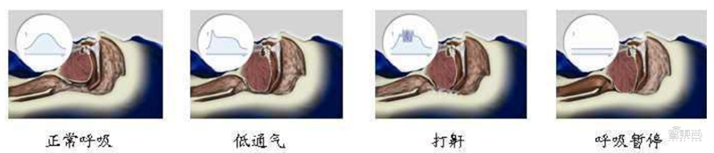 揭秘全球都在抢购的呼吸机！国内产能将近全球两倍【附下载】| 智东西内参