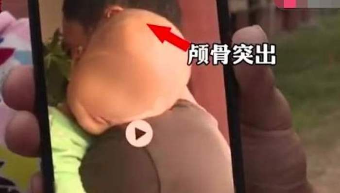 郴州再现“大头娃娃”，伪“特医奶粉”生产方回应称“没有夸大宣传”