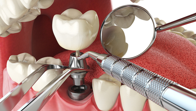 全国第一款含失败责任的种植牙保险上线，颠覆齿科诊疗价值链｜界面创新家㉕