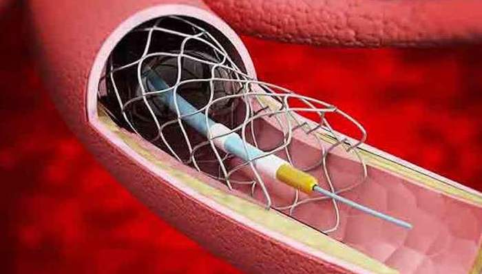 107万个！首次国家组织高值医用耗材冠脉支架集中带量采购来了