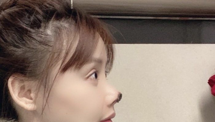 消费者报告｜演员高溜在广州一医美机构做鼻综合手术后鼻头坏死，这种手术风险几何？