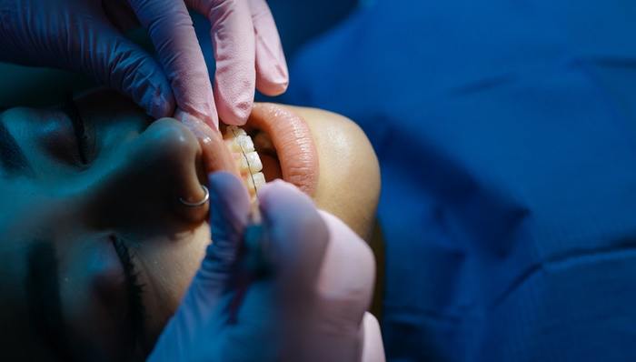 颜值经济,隐形牙套