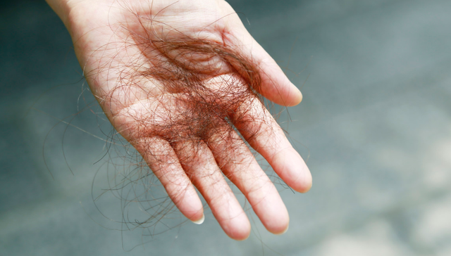 脱发经济,男性医美