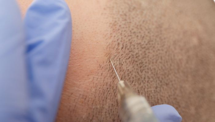 雍禾医疗,植发生意