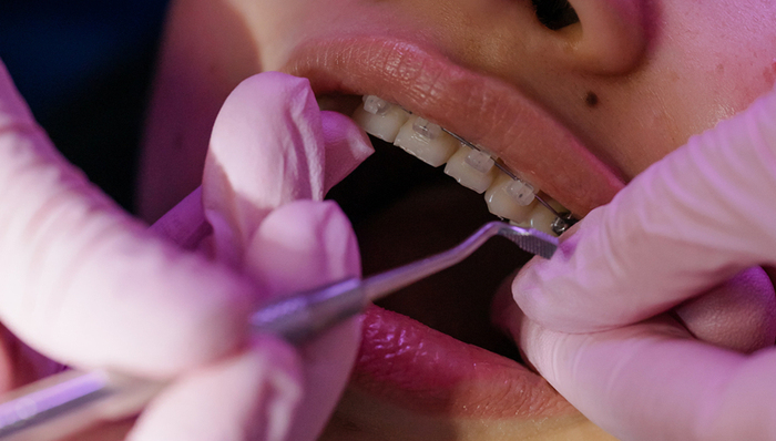 牙科,正畸,消费趋势