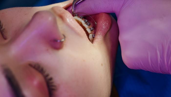 牙齿正畸,毛利高,隐形牙套