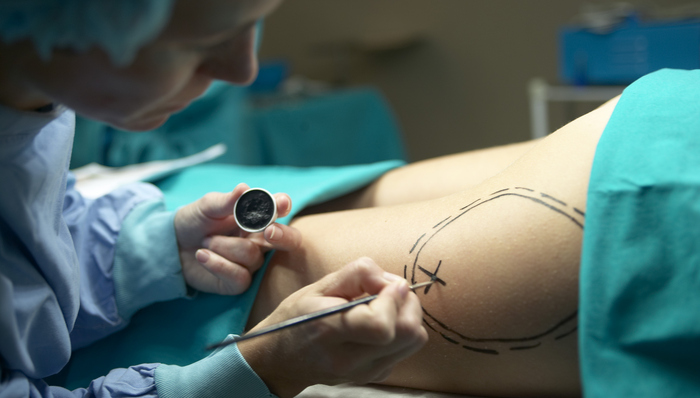 只有0.1%感染率的抽脂术，最后竟要了杭州一网红的命