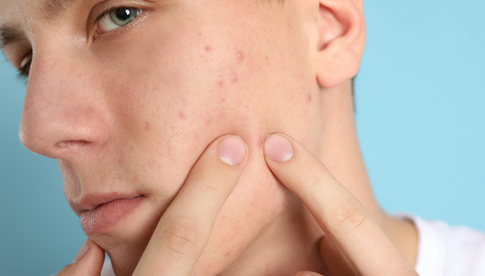 赛诺菲,青春痘,皮肤疾病