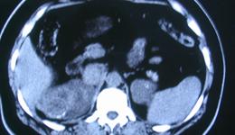 胸部CT“一鱼三吃”