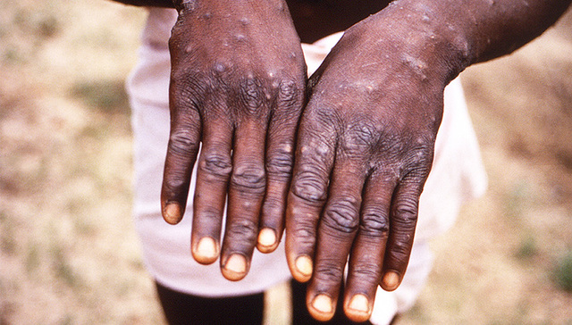 【图集】罕见疾病猴痘：全球多国报告确诊病例，未来几天或有更多