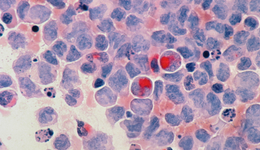 吸金狂热之后，肿瘤早筛的拐点来了？