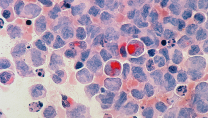 肿瘤早筛,商业化,医疗技术