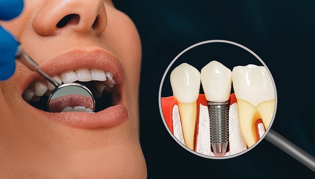 首个种植牙集采落地半年，公立医院参与度为何不高？