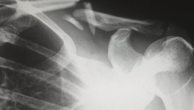 骨科医疗,医保,集中采购