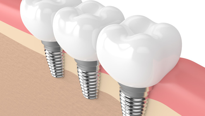 牙科,集采,龙头,预期