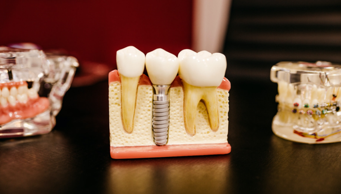 种植牙,口腔医疗
