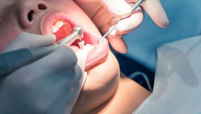 种植牙集采公布1号文件，明确具体品种与竞价规则等