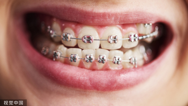 托槽类正畸耗材将集采，时代天使股价应声大跌却是躺枪