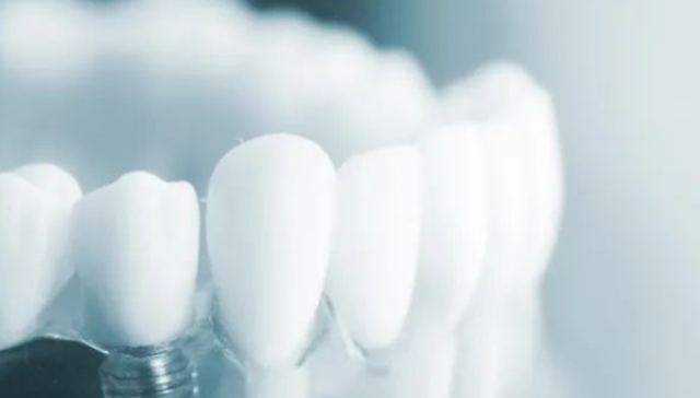 牙科,口腔耗材,行业观察,正畸