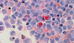 年新增患者不到实体瘤10%，为什么血液瘤“重磅炸弹”更多？