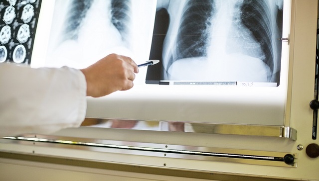 什么是“白肺”？有肺炎就是“白肺”吗？