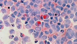 火遍电生理的脉冲消融技术，能否再度颠覆肿瘤治疗？