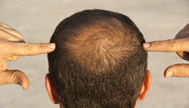 首款青少年治脱发药在国内获批，每盒价格或超千元