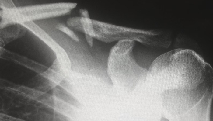 人工关节,集中采购,降价,行业趋势,