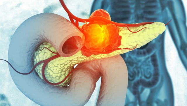 胰腺癌，瑞金医院