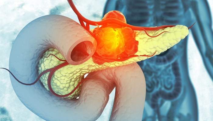 胰腺癌，瑞金医院