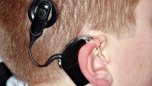 外周血管支架与人工耳蜗集采在即，降价幅度至少过半