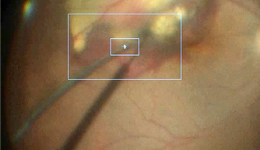 蔡司、索尼入局，国产强势起跑，手术机器人下一个爆发点来临