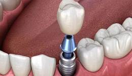 種植牙市場巨變，國產(chǎn)種植體成最大贏家？