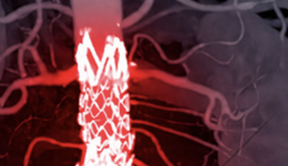 集采落选、断供警告，难以替代的外周动脉覆膜支架